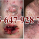 Illustration for article titled obat tradisional penyakit kelamin herpes